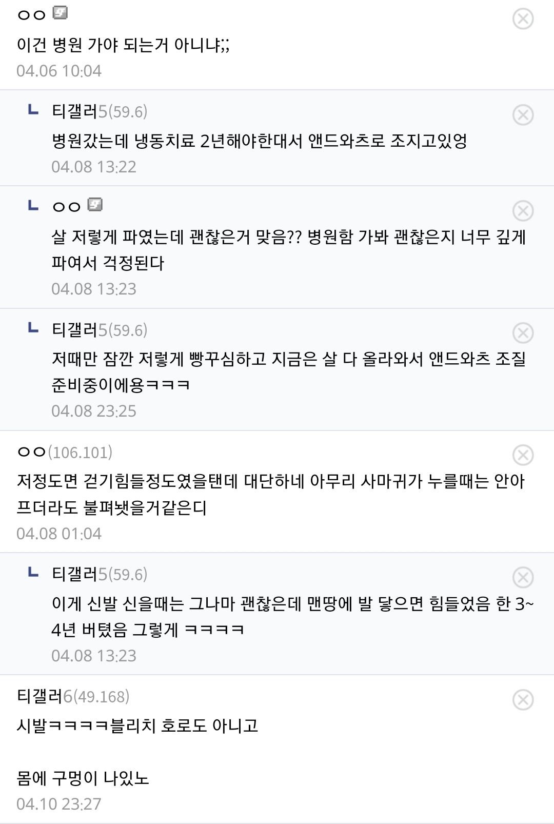 극혐. 발에 구멍이 나있는 티눈 갤러 - 유렉카 채널 004.jpg